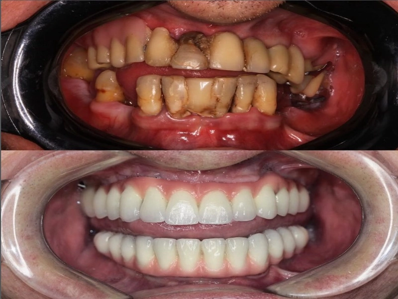 Implantes Dentários